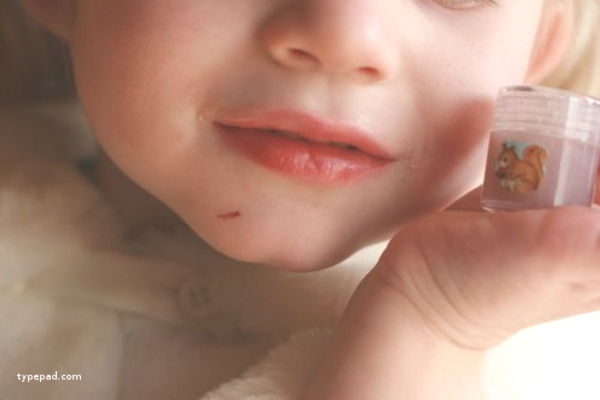 Mengobati Sariawan Si Kecil