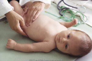 Jangan Sepelekan Hernia Umbilikal