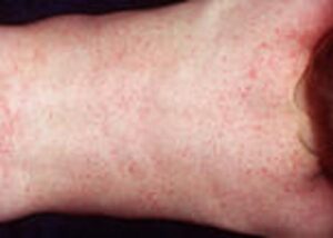Waspadai Infeksi Virus Roseola