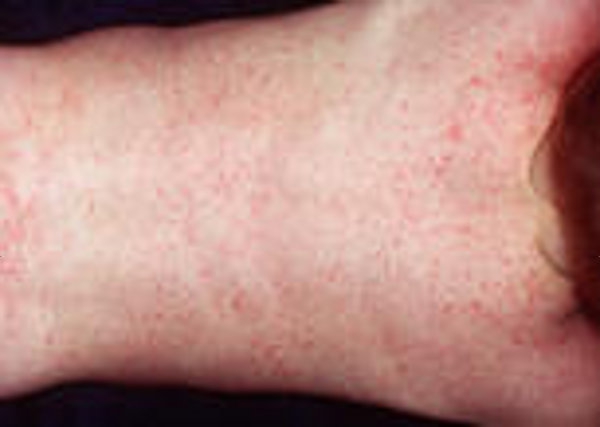 Waspadai Infeksi Virus Roseola