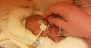 Kisah Kelahiran Bayi Prematur 1 Kilogram