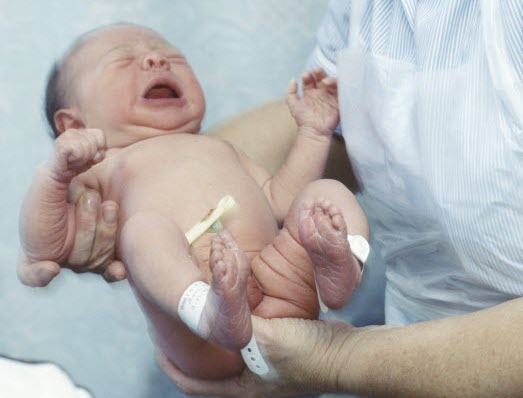 Waspada Hipotiroid pada Bayi