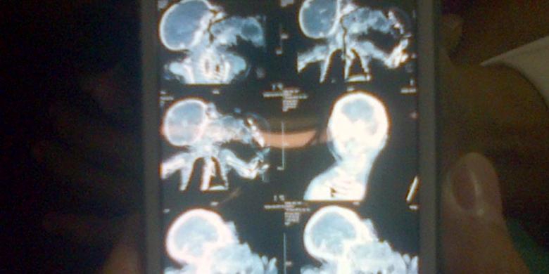 Kembar Parasit (3): Bertahan Hidup dan Jadi Perhatian
