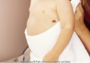 Kenali Jenis Tanda Lahir Bayi