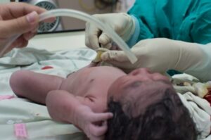 Jika Bayi Mengidap Talasemia (2)