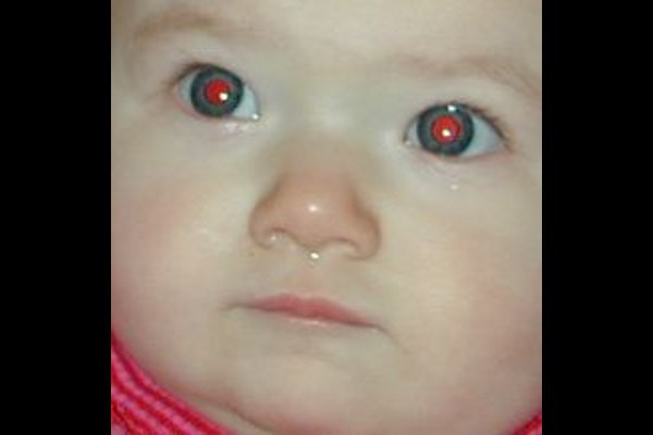 Deteksi Gangguan Mata Lewat Foto Bayi
