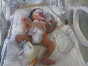 Bayi Tanpa Anus dan Kolon