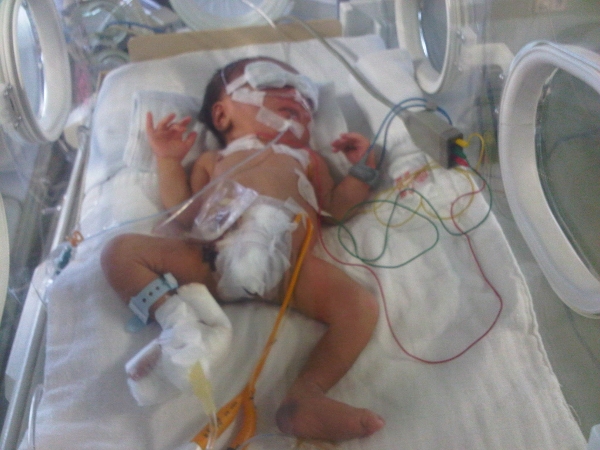 Bayi Tanpa Anus dan Kolon