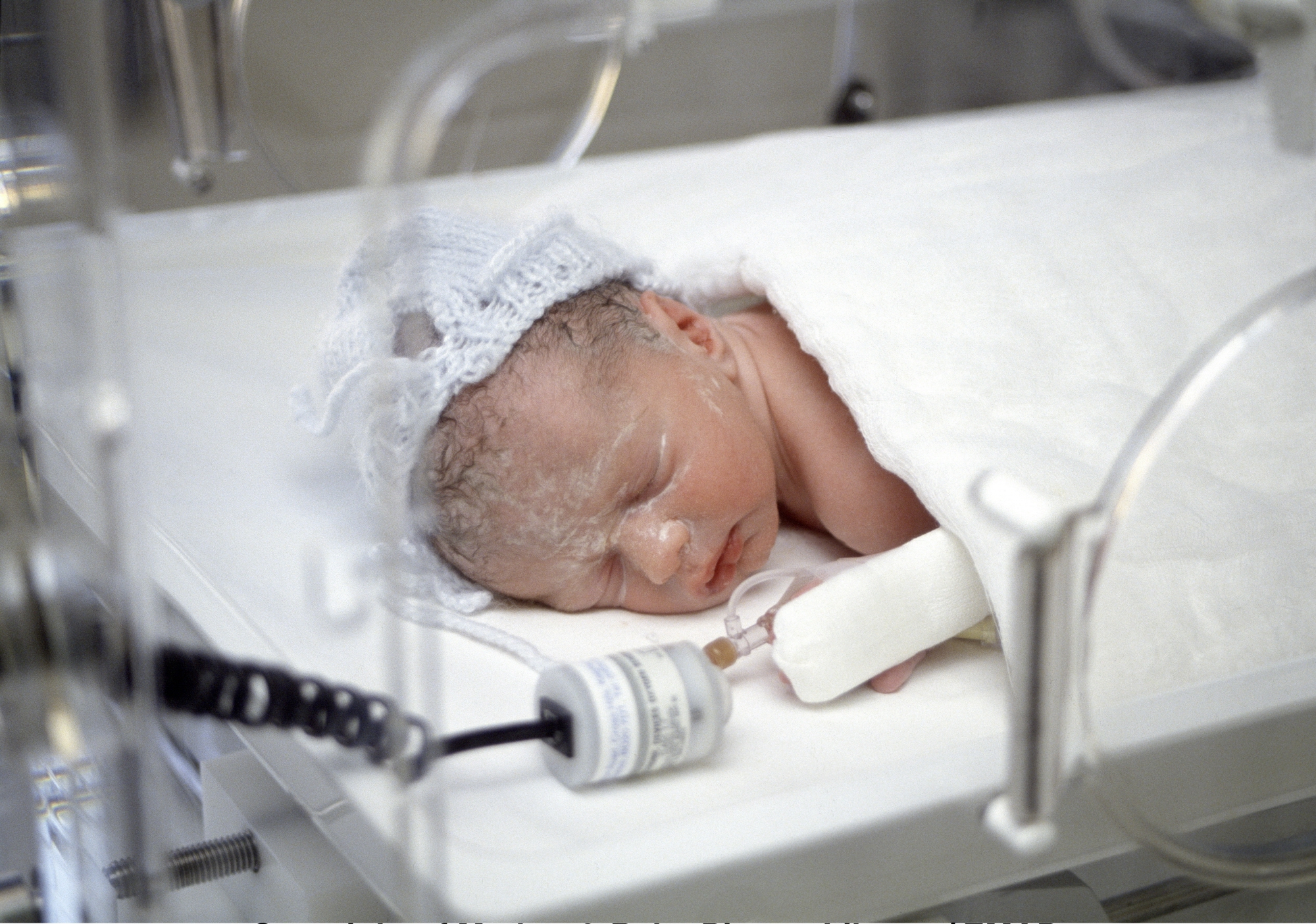 Bayi Prematur Rentan Diabetes