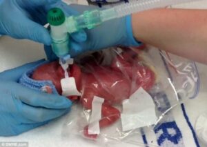 Lucia, Bayi Prematur yang Bertahan Hidup