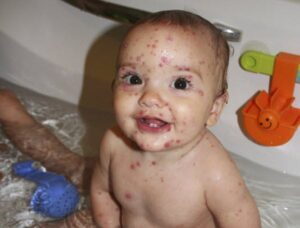 Cacar Air pada Bayi
