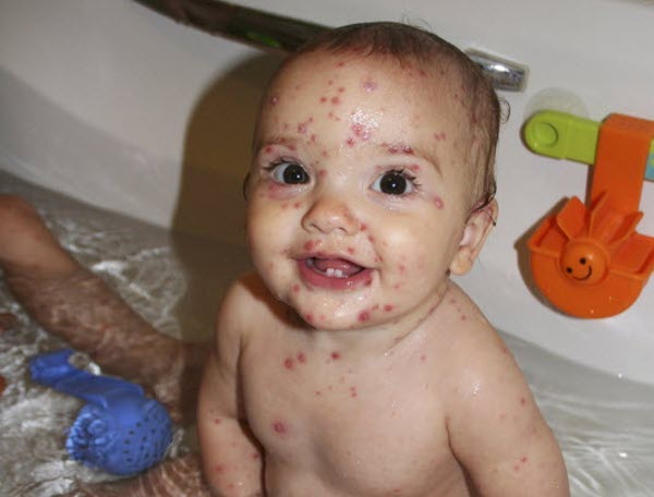 Cacar Air pada Bayi