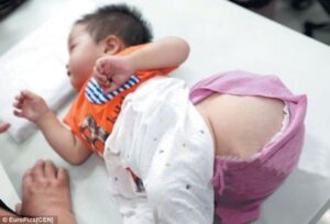 Anak Menderita Tumor Sebesar Melon