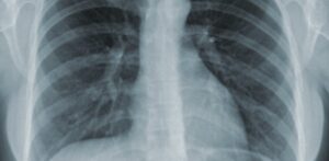 Tuberkulosis Masih Menjadi Momok di Dunia