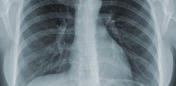 Tuberkulosis Masih Menjadi Momok di Dunia