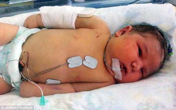 Bayi Dipatahkan Tangannya Agar Bisa Dilahirkan