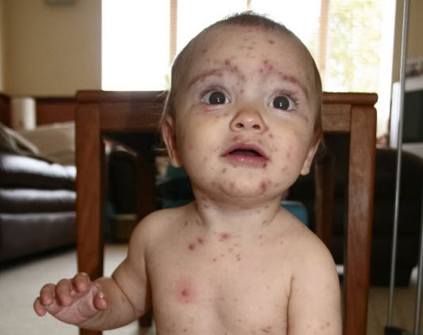 Jika Si Kecil Terserang Rubela