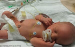 Bayi Lahir Dengan Gastroschisis