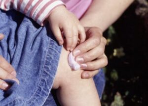 Penanganan Perdarahan Luar Pada Anak Hemofilia