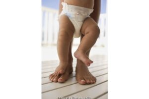 Kelainan Bentuk Kaki Bayi (2)