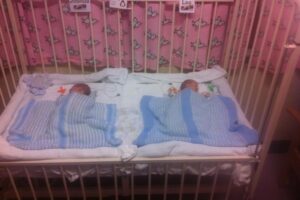 Si Kembar dengan Twin to Twin Transfusion Syndrome Bertahan Hidup