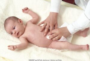 Jenis Hernia Pada Bayi