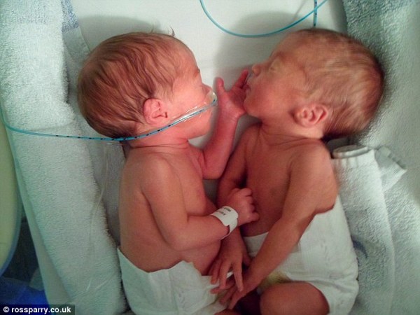 Bayi Kembar di Inggris Meninggal Akibat Leukimia