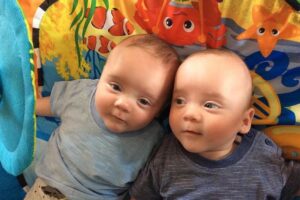 Si Kembar dengan Twin to Twin Transfusion Syndrome