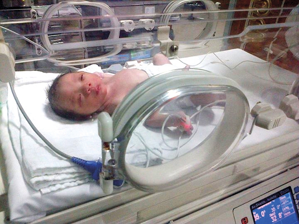 Pierre Robin Sequence (3): Perjuangan Kirana Melawan Penyakitnya