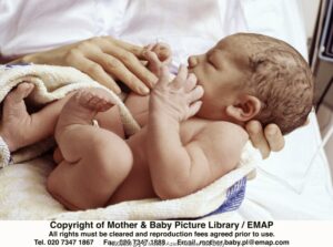 Trauma Lahir (2): Pada Kepala Bayi