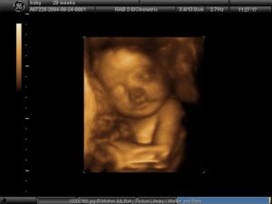 Perlukah USG 3D dan 4D?