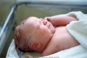 Trauma Lahir (4): Pada Kulit dan Tulang Bayi