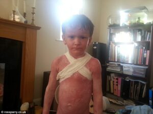 Kasihan, Bocah 4 Tahun ini Menderita Eksem Parah!