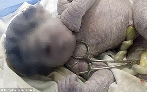 Bayi Bermata Satu Dilahirkan di Mesir