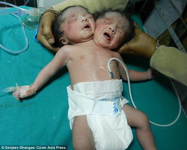 Bayi Berkepala 2 Lahir di Bangladesh