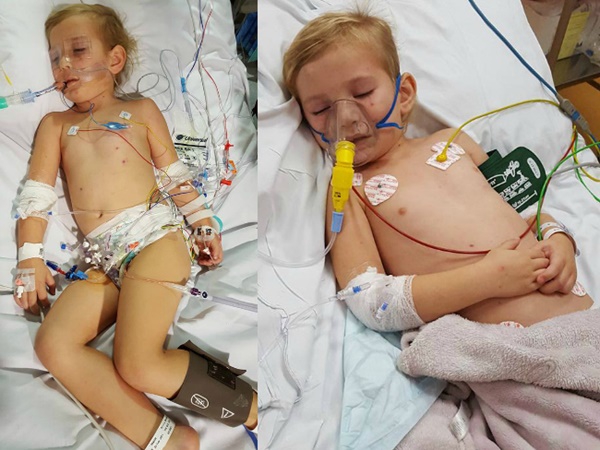 Hanya Dalam 24 Jam, Meningitis Melumpuhkan Balita Ini!