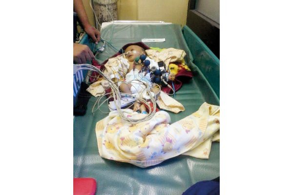 Kisah Faiq (1): Bayi 36 Hari yang Alami Pendarahan Otak