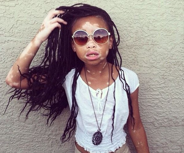 April Star, Anak dengan Kelainan Kulit yang Sukses Jadi Model