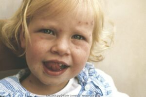 Waspada Impetigo Menyerang Si Kecil!