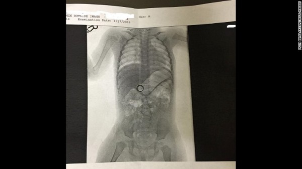 Sebuah Cincin Kawin Ditemukan di dalam Usus Bayi