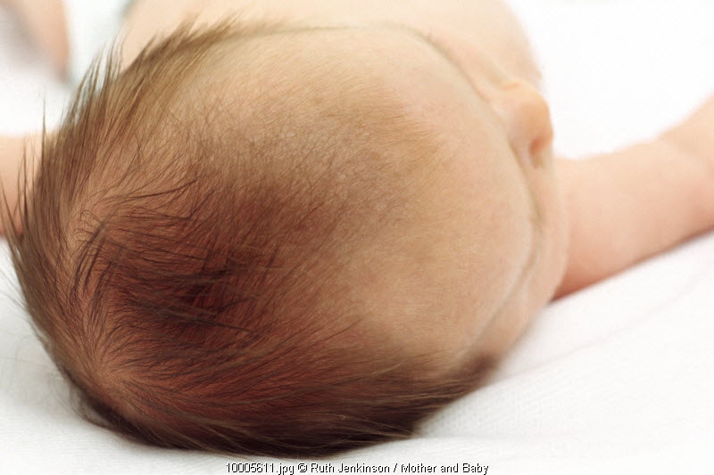 Mengenal Kerak Topi pada Bayi