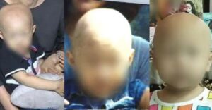 3 Balita Alami Kebotakan setelah Minum Obat Herbal