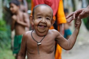 Balita Asal Bangladesh Miliki Wajah seperti Kakek-Kakek