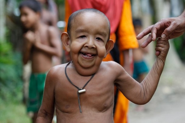 Balita Asal Bangladesh Miliki Wajah seperti Kakek-Kakek