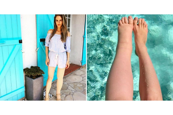 Kaki Wanita Ini Bengkak Sebelah Sejak Hamil