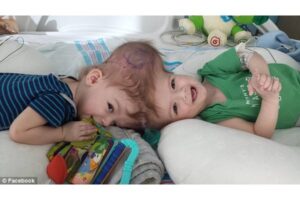 Bayi Kembar Siam di Kepala Berhasil Dipisahkan