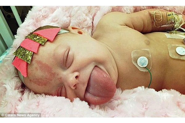 Bayi Berlidah Besar Ini Akhirnya Bisa Tersenyum