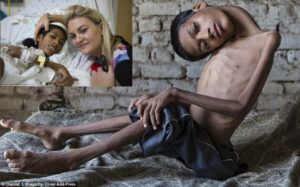 Lewat Internet, Ibu Ini Bantu Anak Berkepala Miring