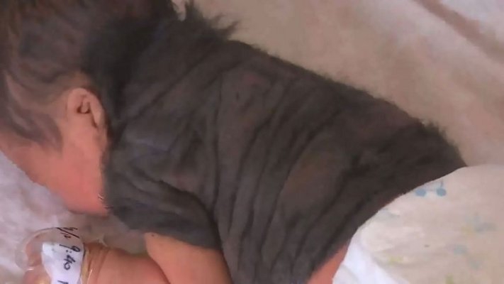 Astaga, Bayi &#8216;Werewolf&#8217; Lahir di China!