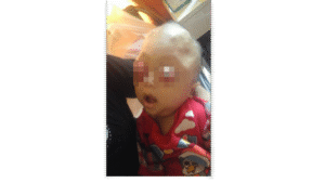 Bayi Asal Lampung Terserang Tumor Mata